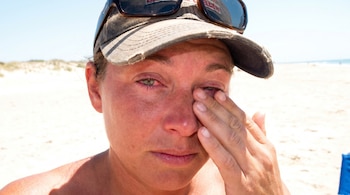 Primer plano de una persona en la playa con gafas de sol en la gorra, frotándose un ojo visiblemente irritado y enrojecido bajo la luz del sol.
