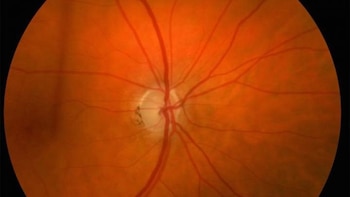 La alineación del cristalino condiciona