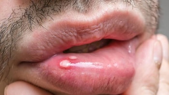 Primer plano de la boca y el labio inferior de una persona con vello facial. El labio inferior muestra dos lesiones blancas y piel enrojecida