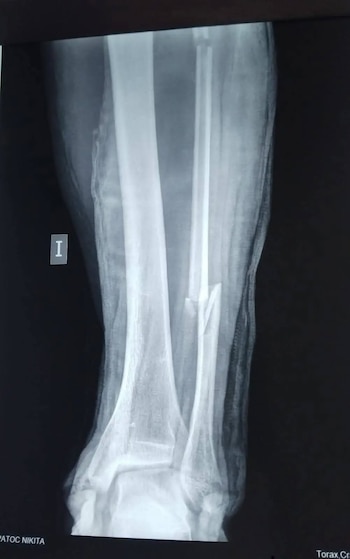 Tras ser trasladado al hospital