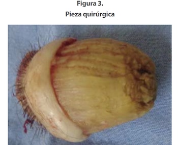 El cuerno fue extirpado y