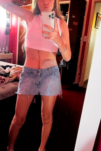 La historia de Clara, la joven que decidió mostrar su bolsa de ostomía en redes: “No me quiero perder nada de la vida”
