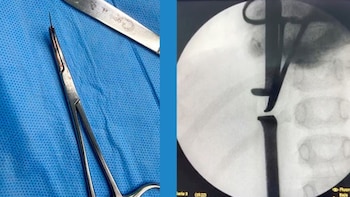 El equipo médico recurrió a la fluoroscopia para ubicar con precisión la aguja y reducir los riesgos de la cirugía - Créditos: INSN.