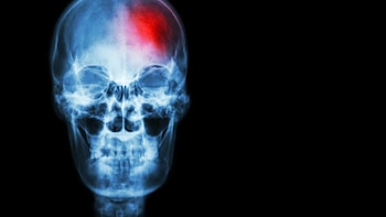 Descubren cómo un metabolito de las bacterias intestinales puede influir en el daño cerebral tras un ictus
