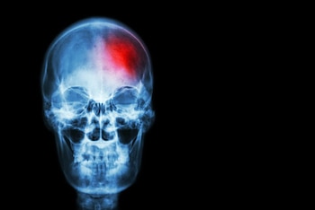 Ictus
SALUD
STOCKDEVIL/ ICTUS