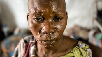 África registra casi 25.000 casos