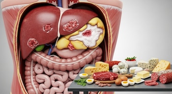 Corte transversal del abdomen humano con hígado graso inflamado y mesa con carnes, quesos y huevos al frente.