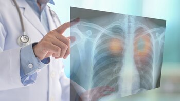 Cáncer de pulmón: la importancia