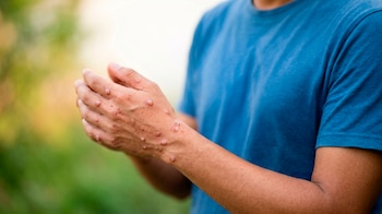 El Gobierno nacional activó protocolos de investigación de campo, seguimiento epidemiológico y monitoreo de contactos para detectar posibles exposiciones al mpox y proteger la salud pública - crédito Ministerio de Salud