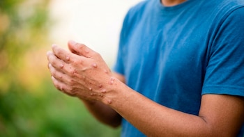 Gobierno nacional reforzó la vigilancia epidemiológica tras caso de mpox clado Ib en Antioquia: el paciente sigue bajo monitoreo