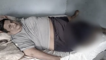 Extirparon un tumor de 40 kilos a un paciente que llevaba cinco años sin poder caminar