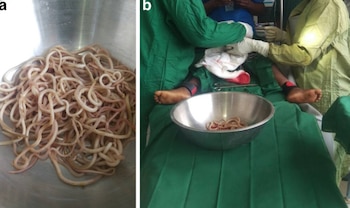 Ascaris lumbricoides