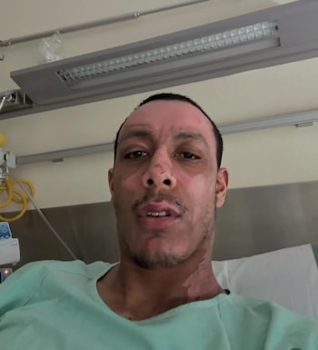 Álvaro Hidalgo en proceso de recuperación tras graves quemaduras.