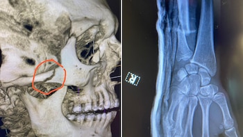 Las fracturas de pomulo y