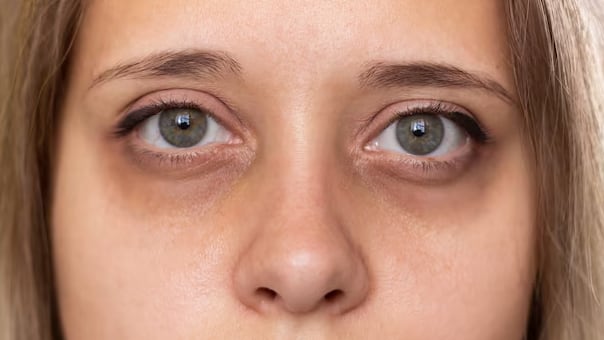 la predisposición a las ojeras se debe en gran parte al ADN, que determina el grosor y la pigmentación de la piel bajo los ojos (Crédito: Freepik)