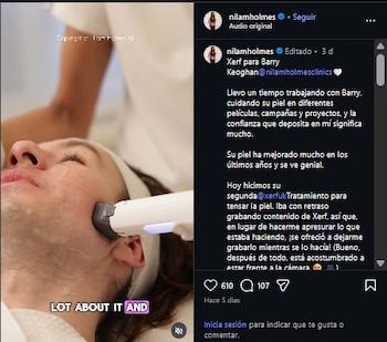 Barry Keoghan se sometió a un procedimiento estético para mejorar su piel.