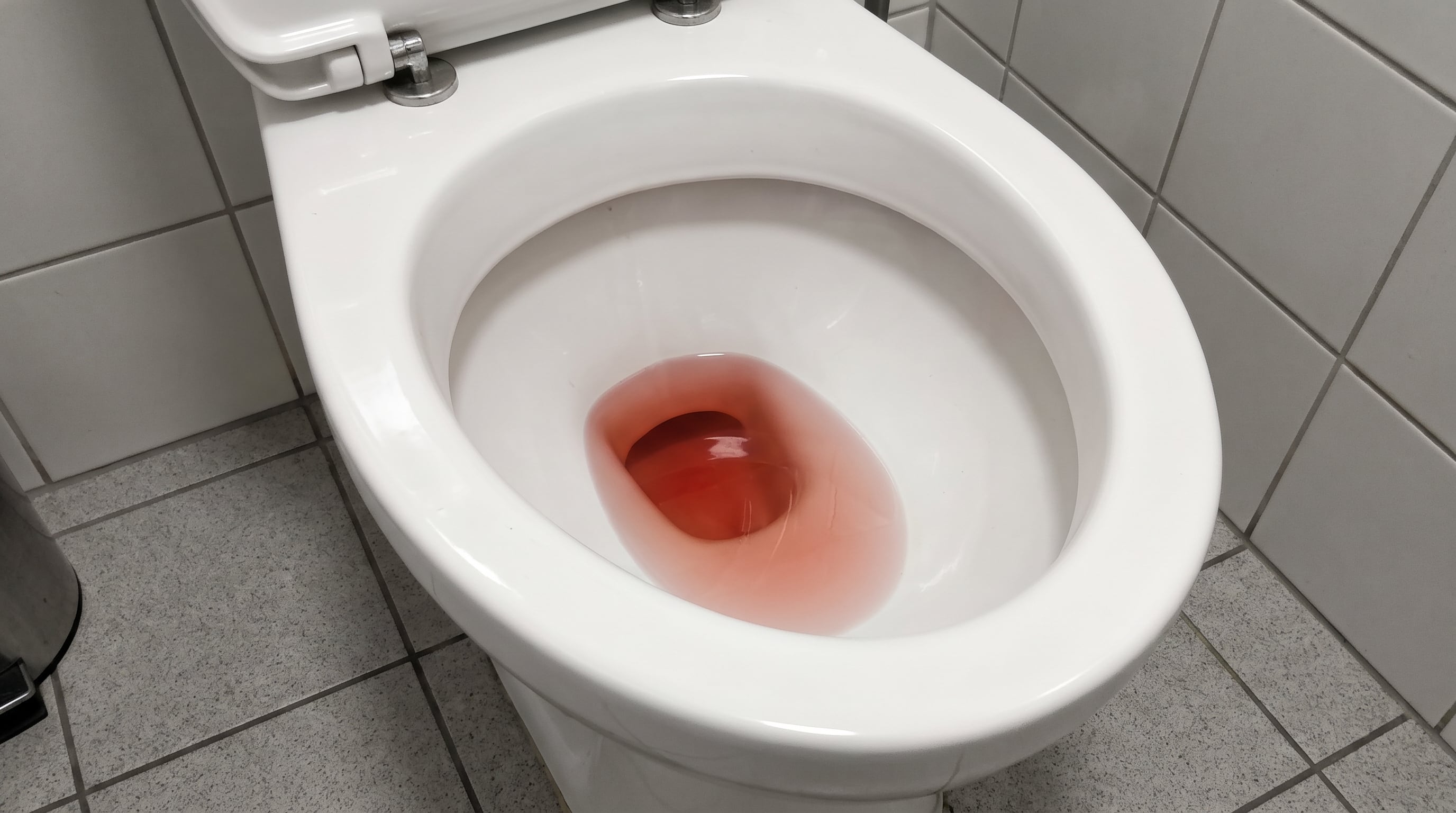 La orina roja o rosada puede deberse a alimentos como remolacha, moras o ruibarbo, pero también puede indicar sangrado urinario (Imagen Ilustrativa Infobae)