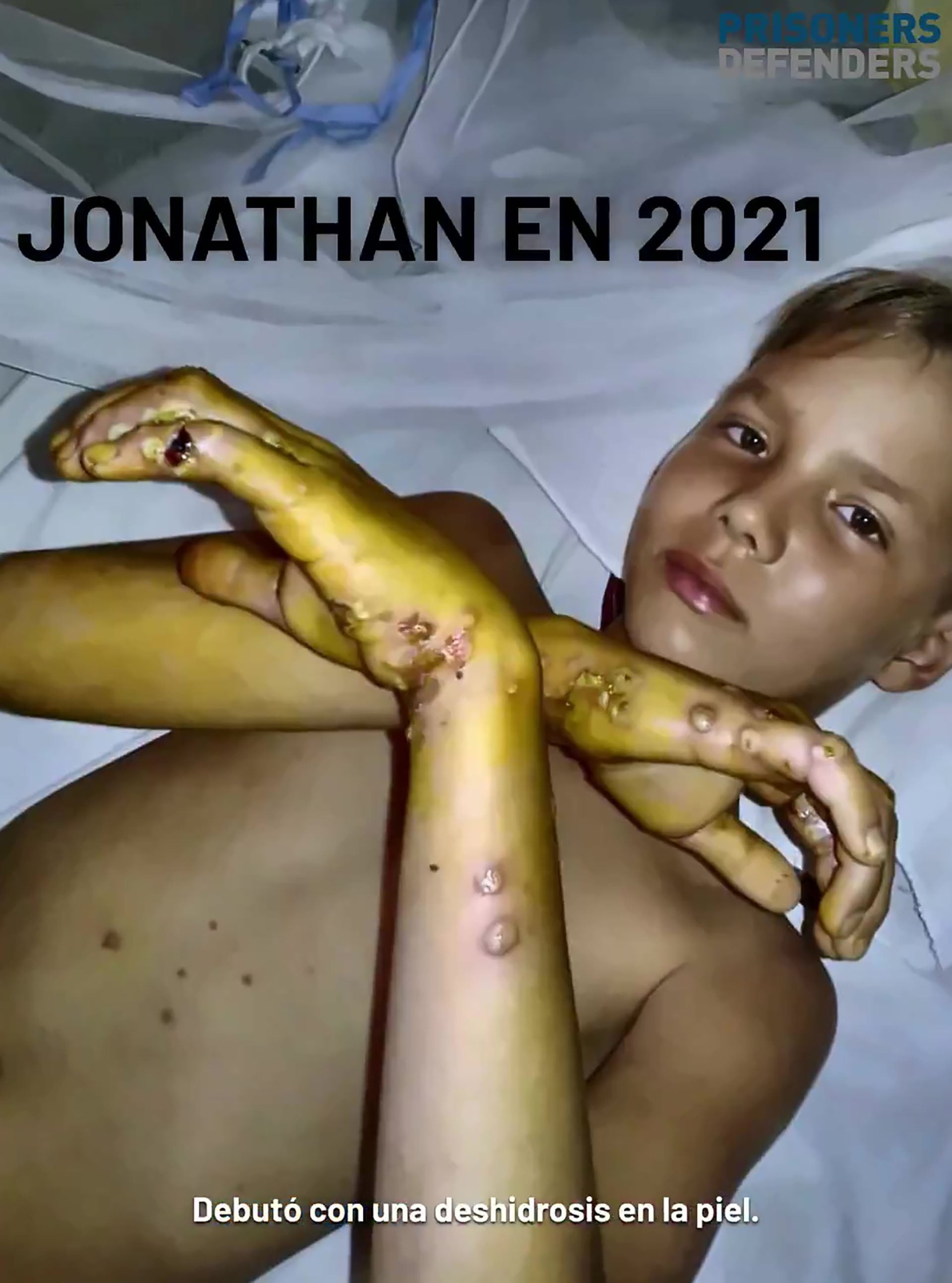 Jonathan David Muir Burgos muestra las graves secuelas de la deshidrosis que afectó su piel en 2021, reflejando su difícil situación (Captura de video)