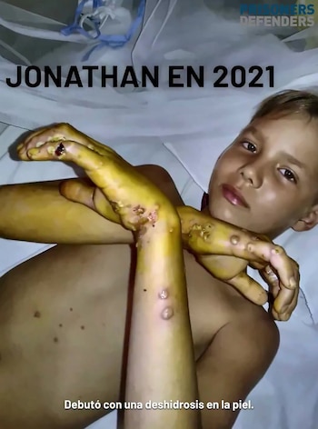 Un niño joven, Jonathan David Muir, con la piel de los brazos y manos amarillenta y con úlceras o ampollas. Se ve parte de su torso con manchas. Fondo claro