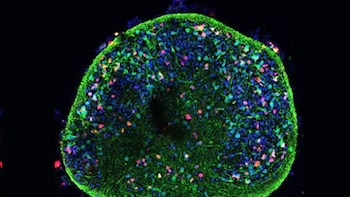 Alteraciones celulares del Alzheimer, observadas