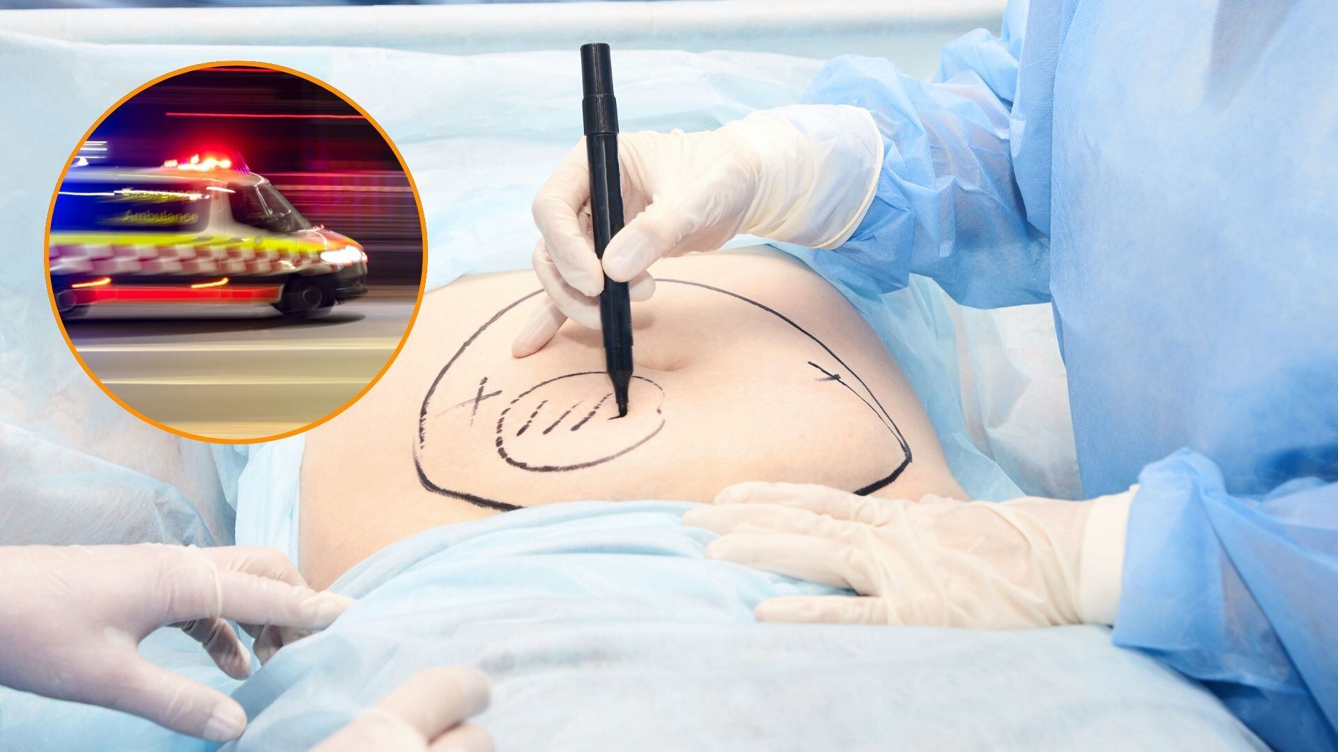 Una mujer fallece tras realizarse una liposucción. (Canva)