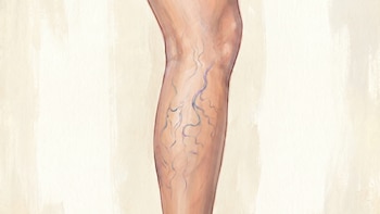 Varices: qué son, cómo surgen y cuándo pueden indicar una afección grave