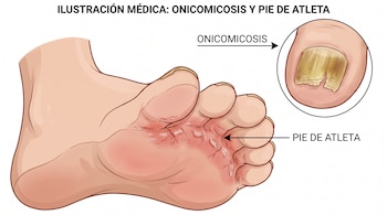Ilustración médica de un pie humano con onicomicosis en una uña del dedo gordo y pie de atleta en la planta y entre los dedos.