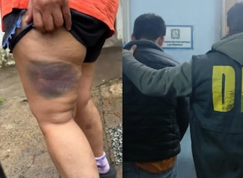Fotografía dividida que presenta un hematoma en el muslo de una persona y a un hombre escoltado por un agente de seguridad