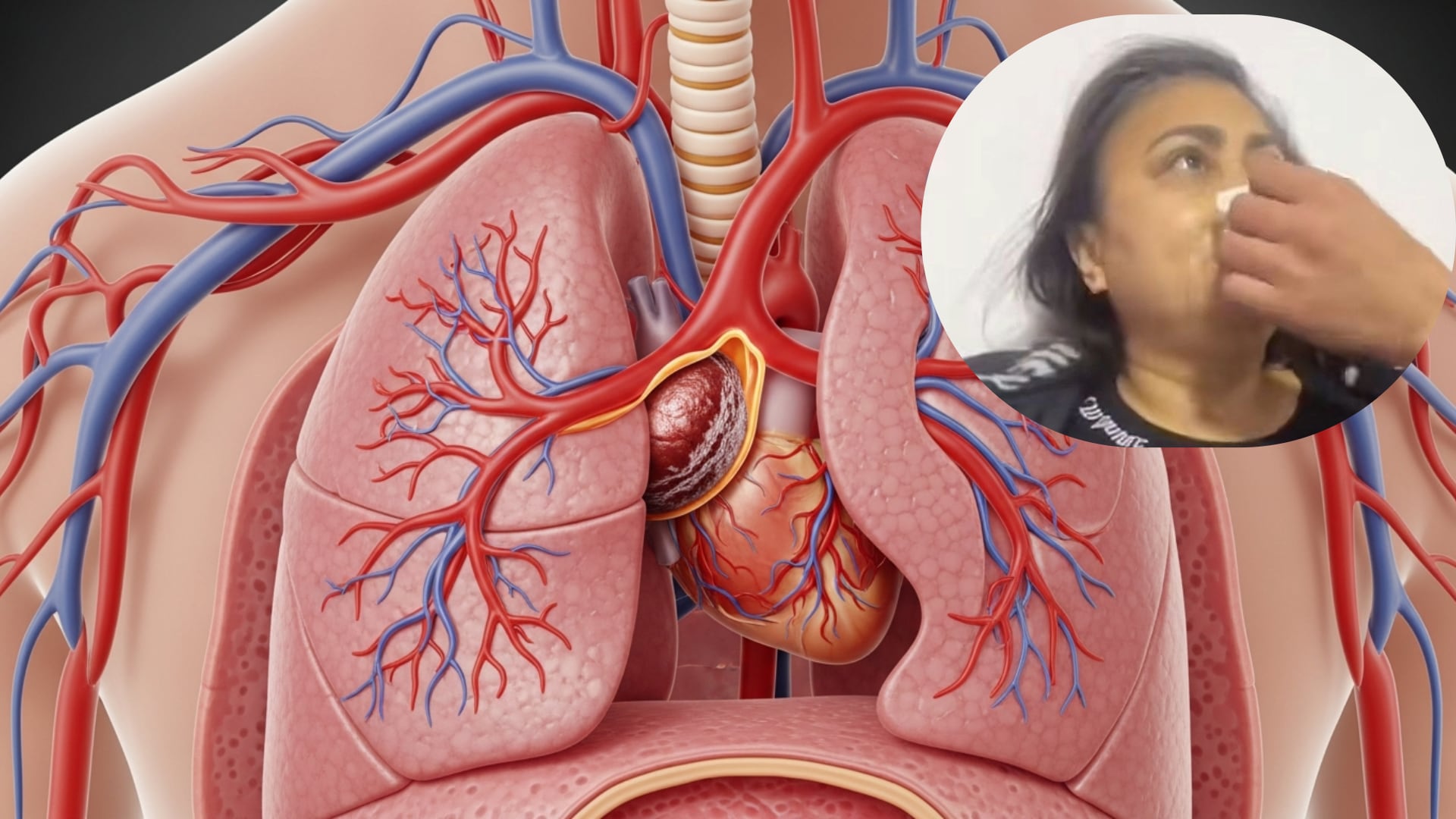 Peritos analizarán si existió mala praxis médica y examinarán las lesiones sufridas durante y tras el procedimiento estético realizado en el sur de Bogotá - crédito @diegoariasf1/TikTok/VisualesIA/Imagen Ilustrativa Infobae