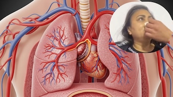 Qué es una embolia pulmonar, la causa de muerte de Yulixa Toloza, según el dictamen de Medicina Legal