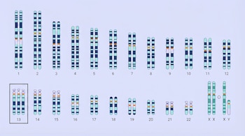 Diagrama de un cariotipo humano con 23 pares de cromosomas ordenados numéricamente. El cromosoma 13 muestra tres copias.