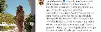 Violeta Bergonzi mostró los resultados de los tratamientos que usó para mejorar la fibrosis abdominal - crédito @violetabergonzi/ Instagram