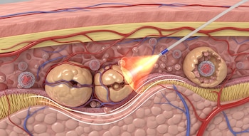 Representación 3D de un corte transversal de la piel con una sonda láser emitiendo luz sobre células grasas bajo las capas dérmicas y vasos sanguíneos.