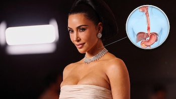 Qué es la esofagitis, la afección que llevó a Kim Kardashian a una intervención