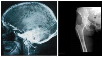 Qué es el mieloma múltiple