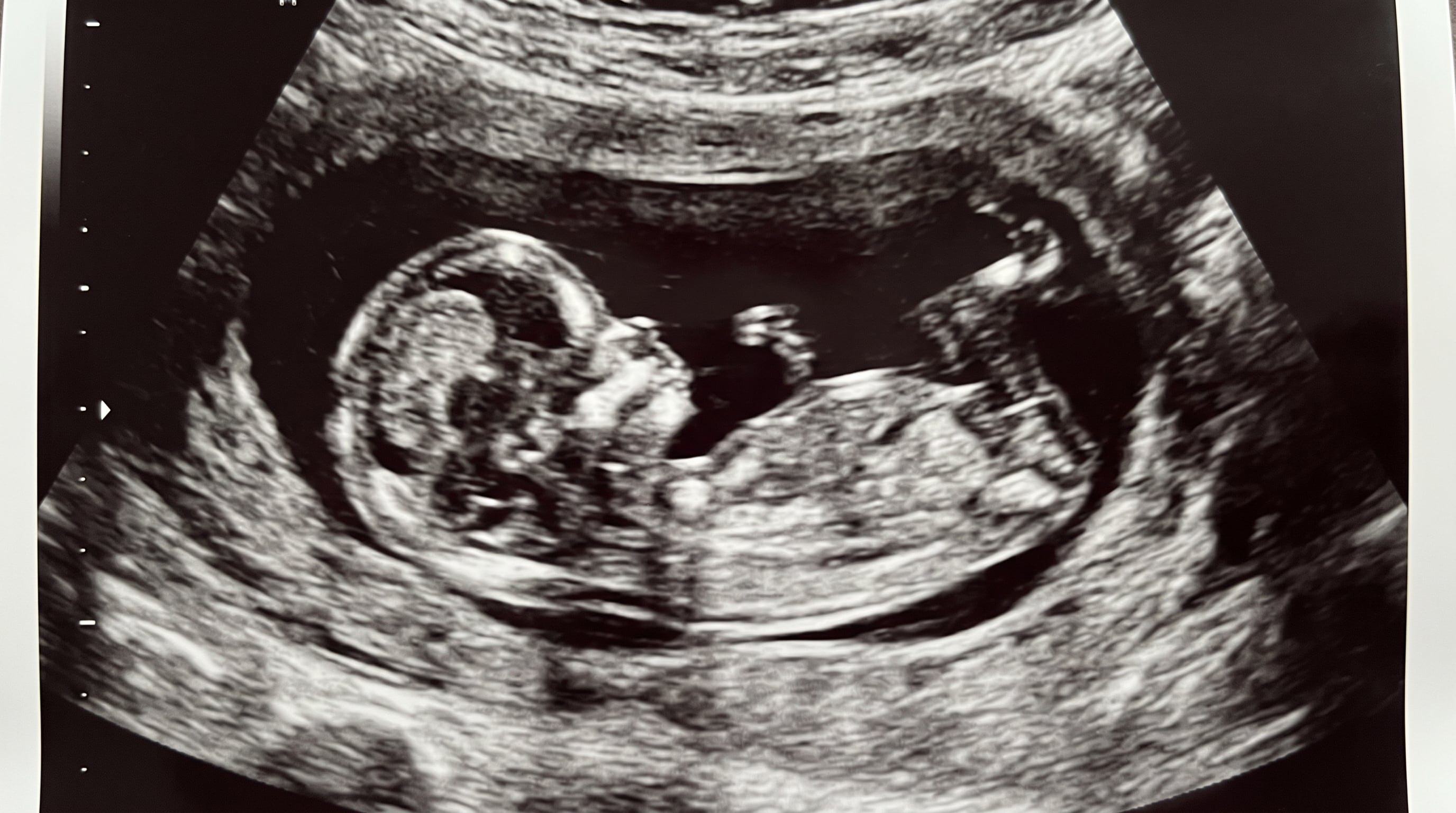 Una ecografía obstétrica muestra la silueta de un feto durante una consulta de control prenatal. (Imagen Ilustrativa Infobae)
