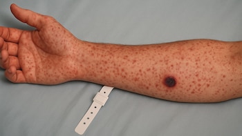 Mueren dos menores tras picaduras