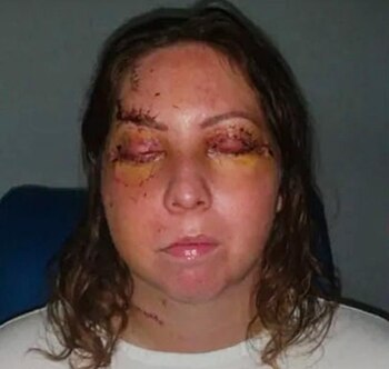 Lexie tuvo que someterse a