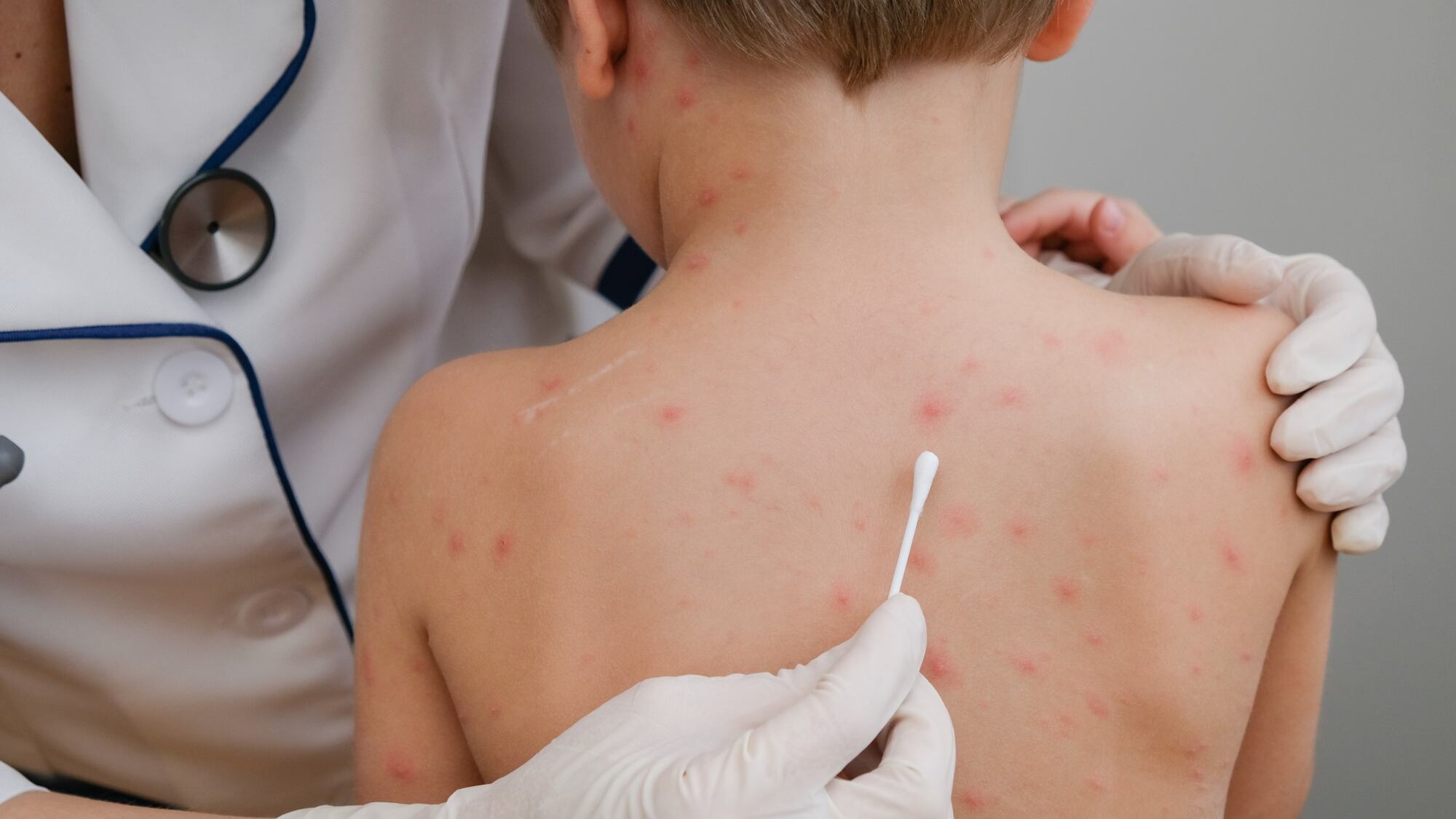 La aparición de manchas rojas que avanzan desde la cara al resto del cuerpo, junto con las manchas de Koplik en la boca, orienta el diagnóstico clínico (Unicef)
