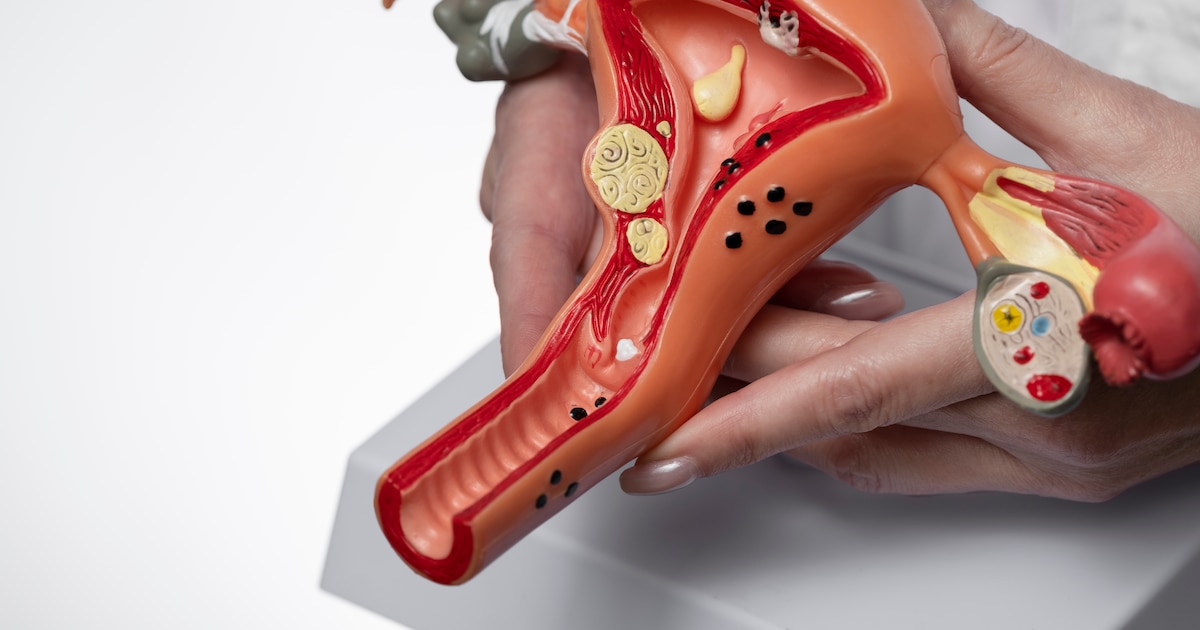 Cáncer de ovario: el origen oculto y los nuevos tratamientos que ofrecen esperanza