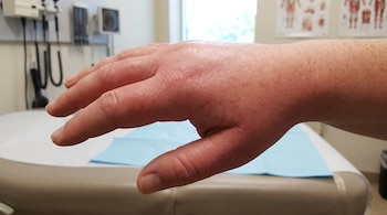 Primer plano de una mano izquierda con hinchazón severa y enrojecimiento sobre una camilla de examen en un consultorio médico con iluminación natural.