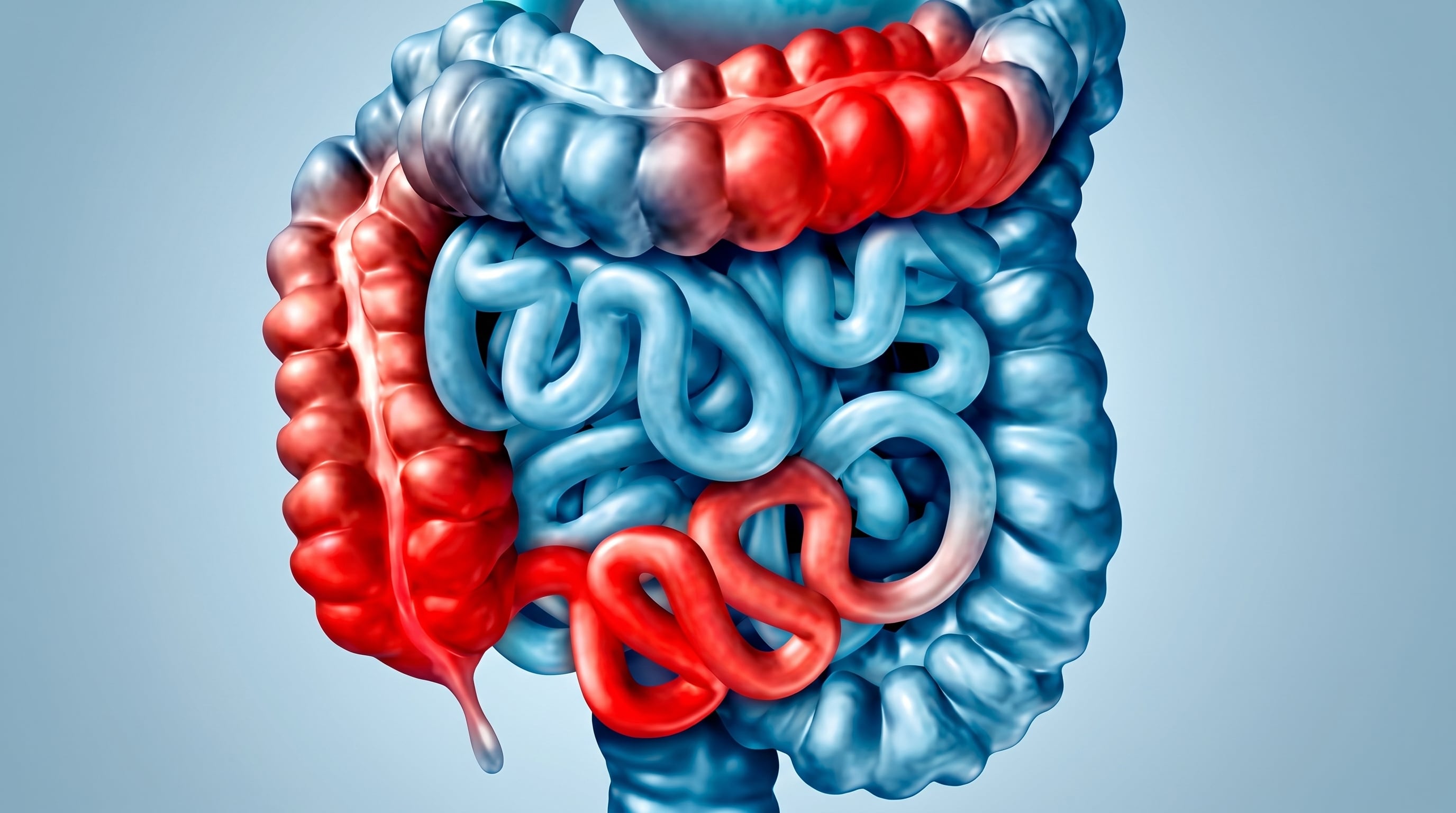 La EII abarca colitis ulcerosa, enfermedad de Crohn y colitis indeterminada, afectando a miles de argentinos (Imagen Ilustrativa Infobae)