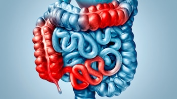 Casos de inflamación intestinal aumentan en jóvenes: estos síntomas podrían confundirse con gastritis, según EsSalud