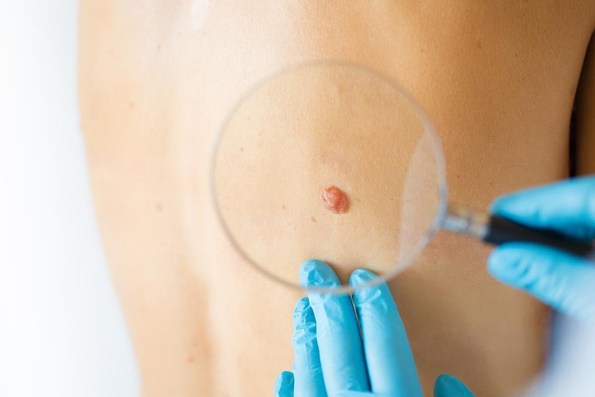 Vacuna contra el cáncer podría mejorar la supervivencia al melanoma, según ensayo