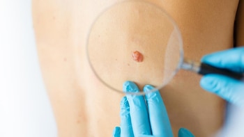 Vacuna contra el cáncer podría mejorar la supervivencia al melanoma, según ensayo