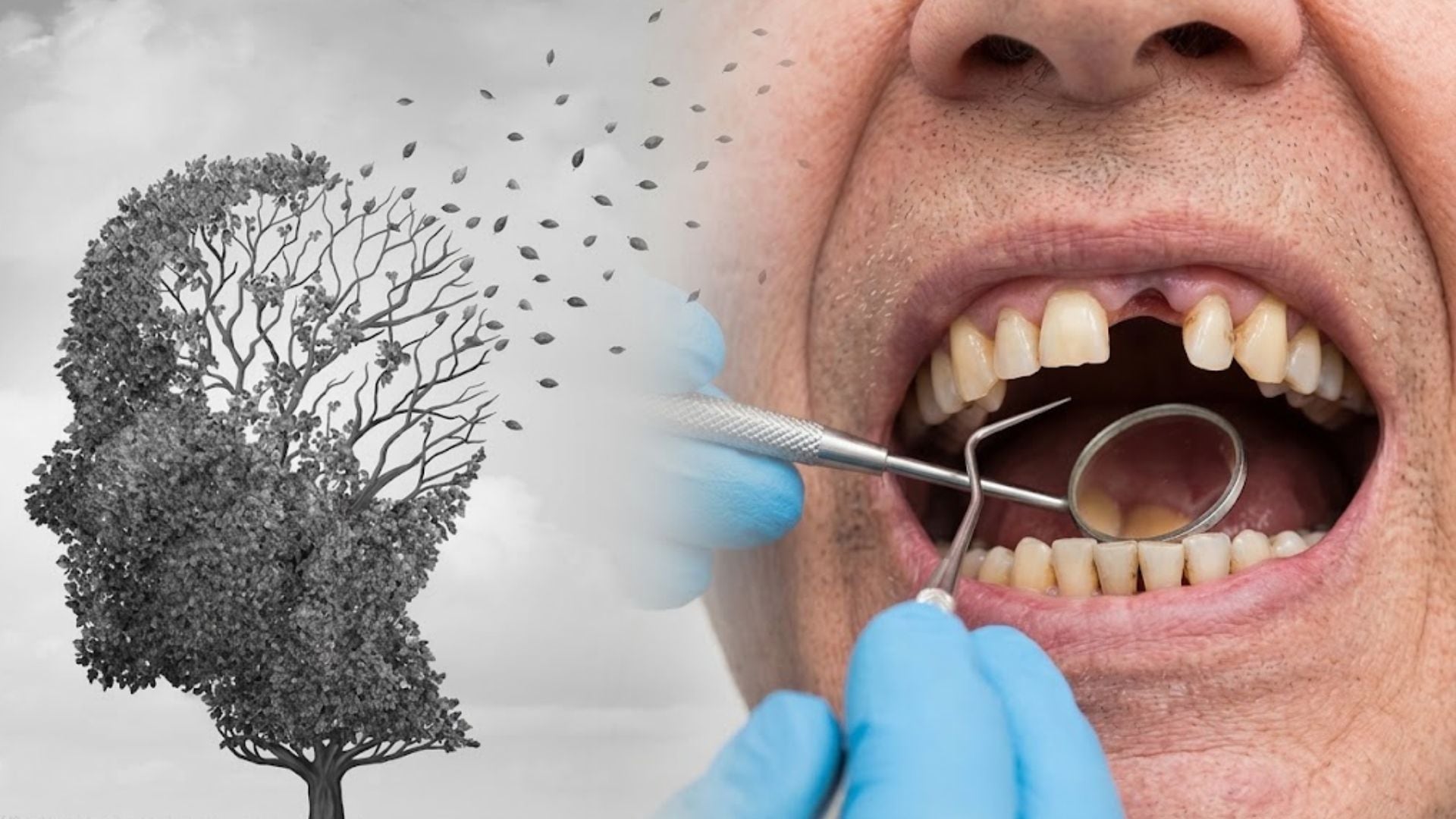 ¿Perder dientes aumenta el riesgo de Alzheimer? Esto explica un especialista sobre la relación con la memoria