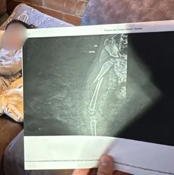 Médicos especialistas diagnosticaron una fractura total en la diáfisis del fémur del niño atendido en una clínica - crédito Captura video City TV