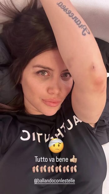 Wanda Nara mostró los moretones