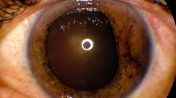 Primer plano de un ojo humano con iris marrón, pupila dilatada, esclerótica con vasos sanguíneos y parte de la piel del párpado superior con pestañas