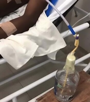 Los médicos debieron usar un